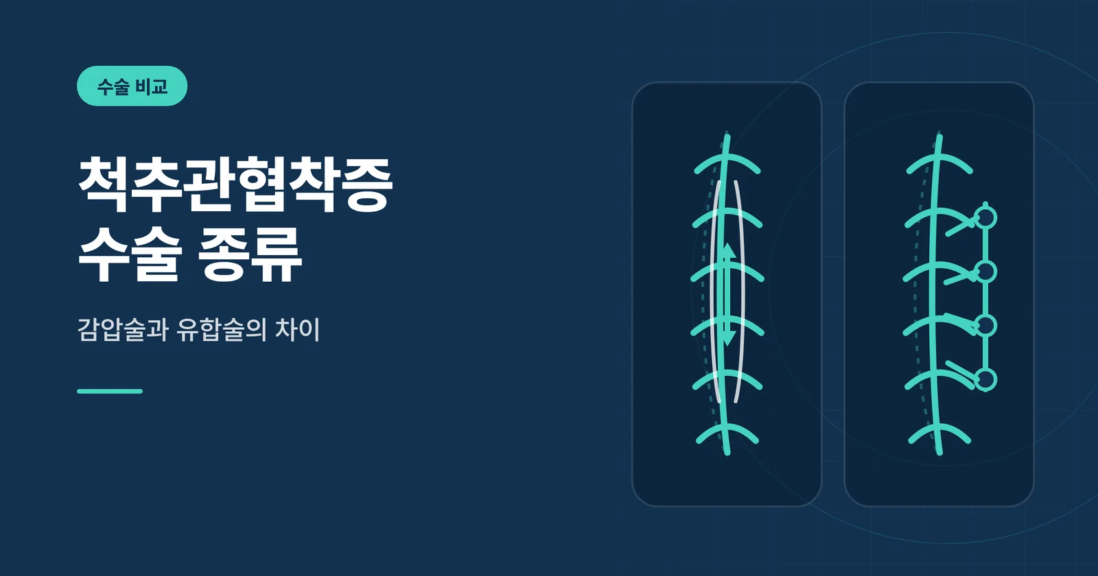 척추관협착증 수술 종류